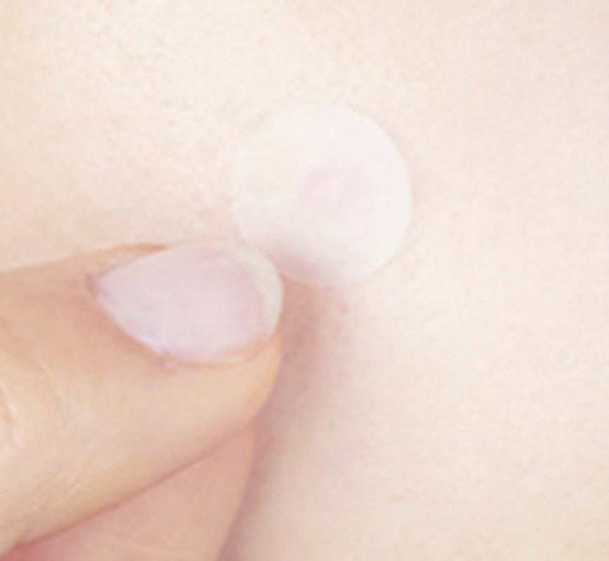 Fingertip pressing a clear hydrocolloid patch onto the skin
